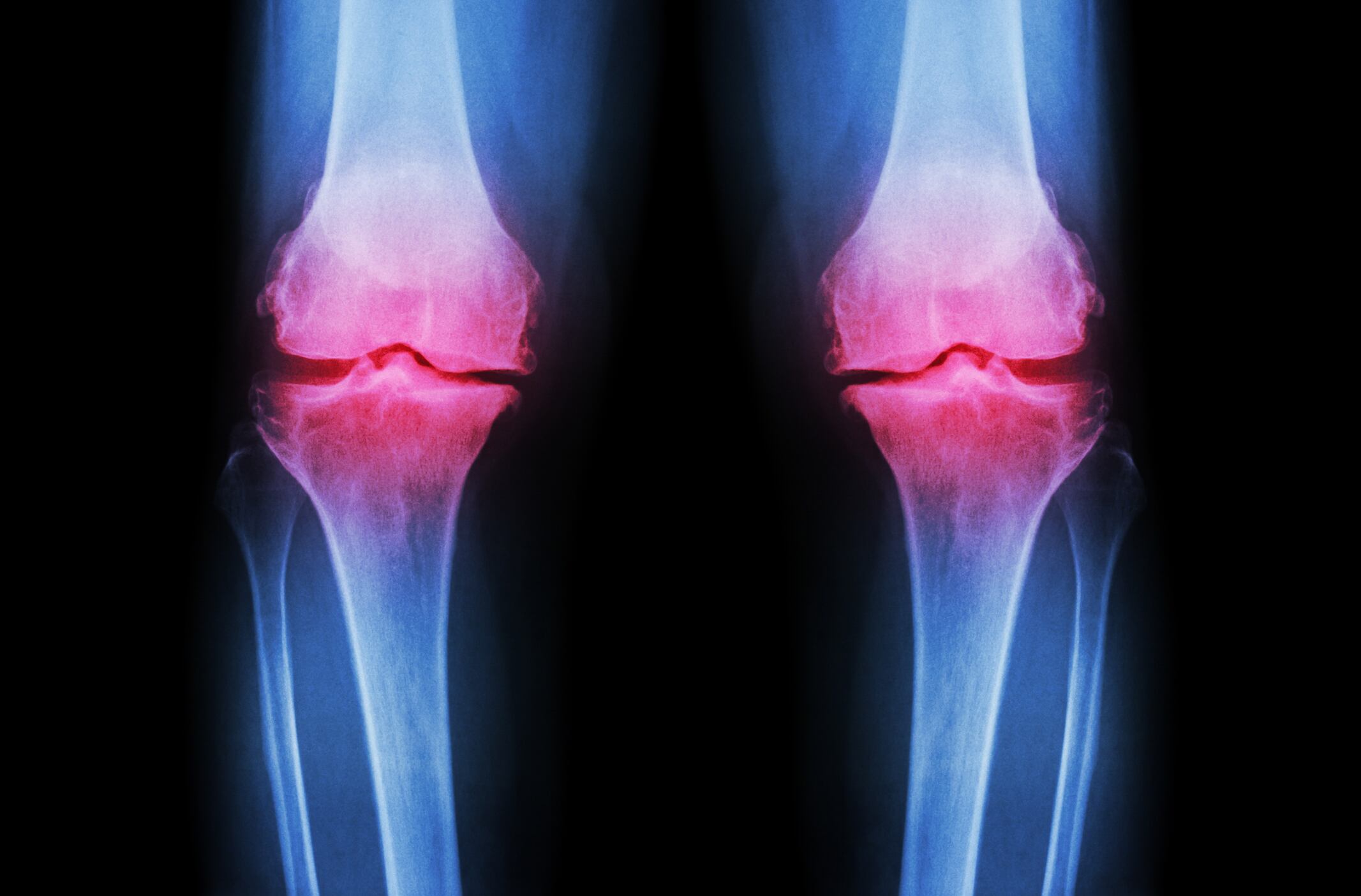 Research rules out antioxidants to prevent bone loss in astronauts