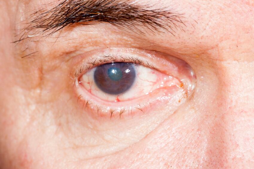 cataract-eye-health-iStock.com-sdigital.jpg