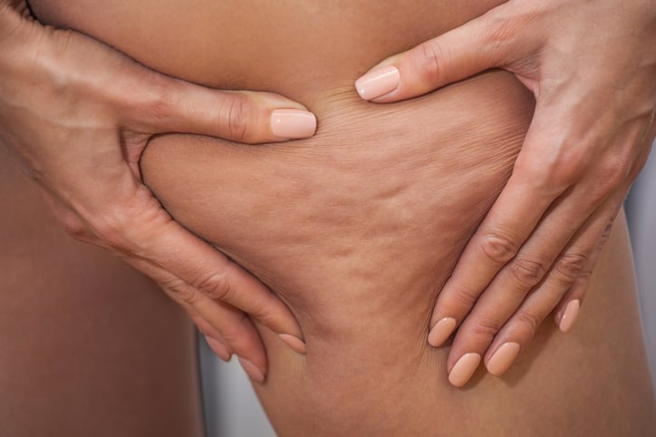 Combined chokeberry and tart cherry shows promise for cellulite reduction
