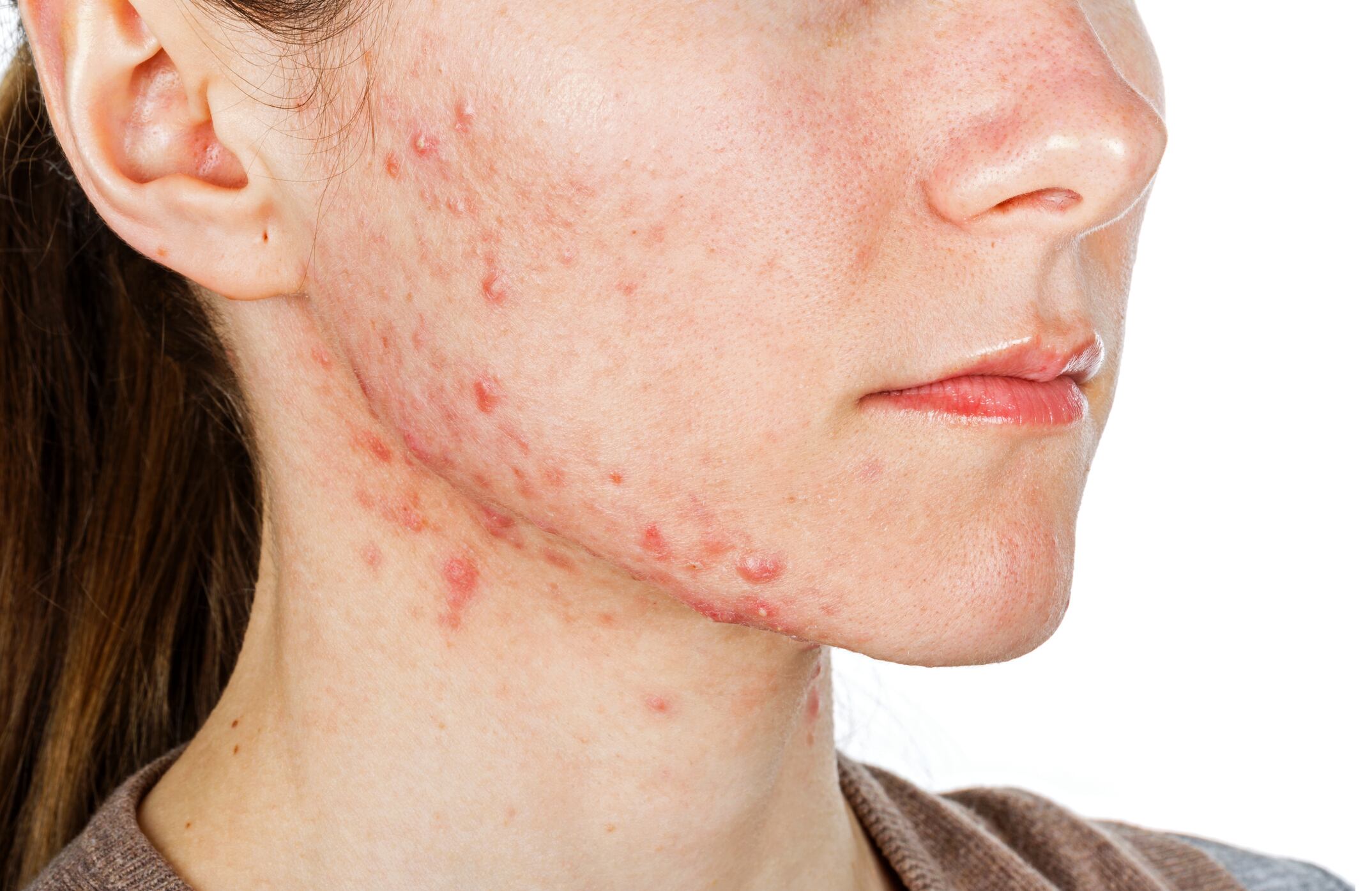 Prebiotic combination shows metabolic benefits for adults with acne: Pilot data