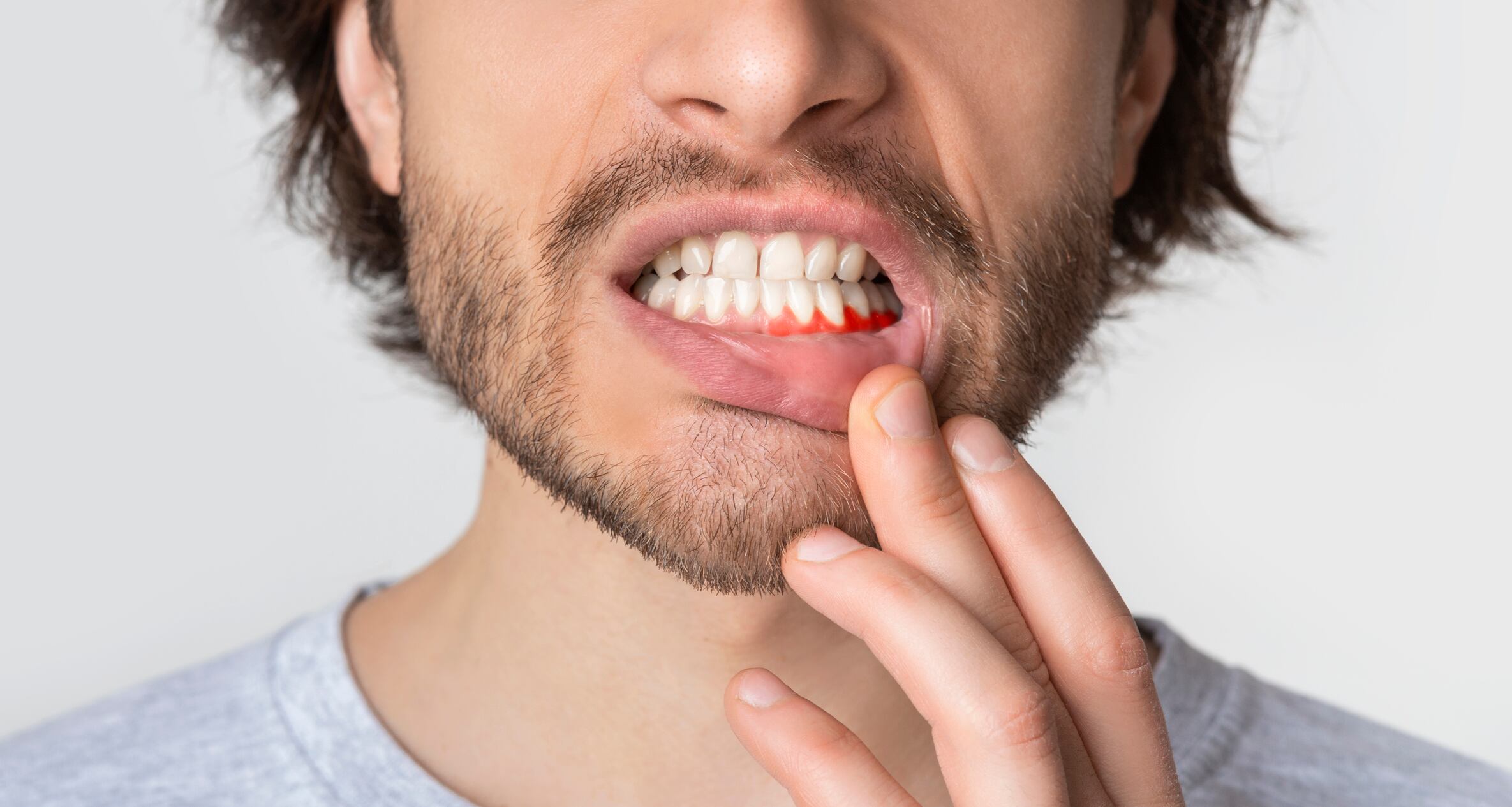 Mangosteen and propolis complex shows potential as gum health supplement