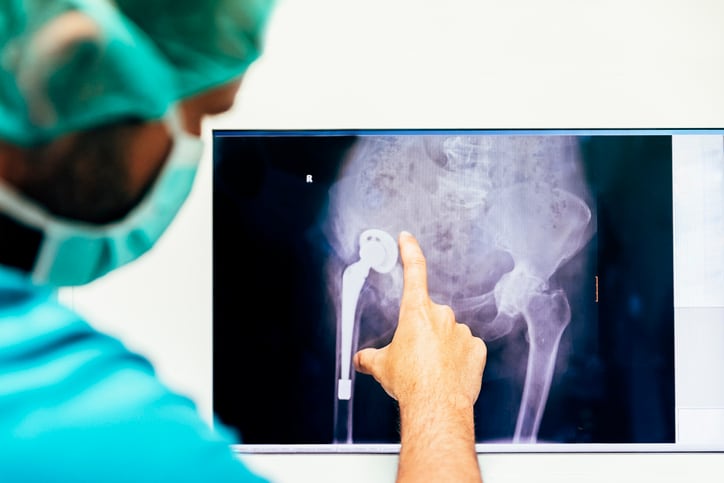 Vitamin D alone doesn't prevent bone fractures: Study 