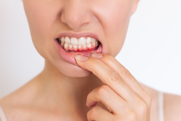 Study: Probiotics aid gum inflammation recovery