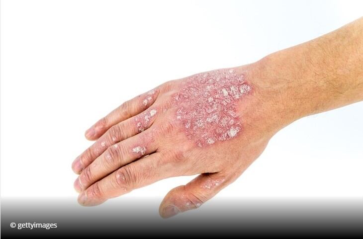 Winclove Probiotics signs psoriasis supplement deal with SkinBioTherapeutics