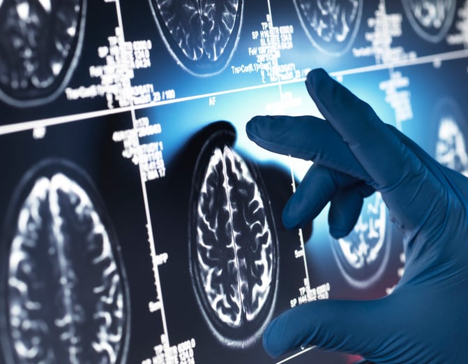 human brain scan on screen