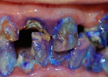 Dirty-teeth-2.jpg