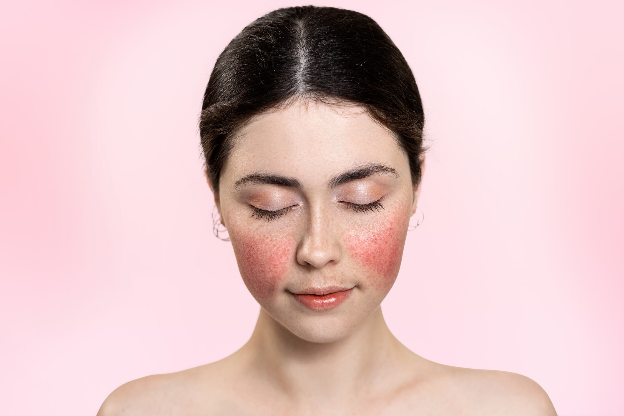 hypersensitive skin and conditions like rosacea, atopic dermatitis and adult acne,