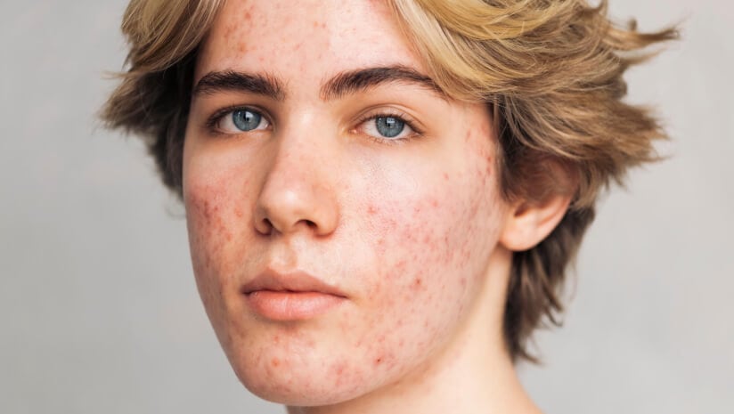 Two supplements may offer acne relief by addressing hormones and the skin-gut axis