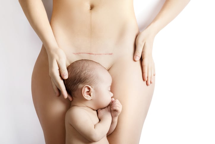 C-section’s toll on gut bacteria prompt scientists to restore infant microbes