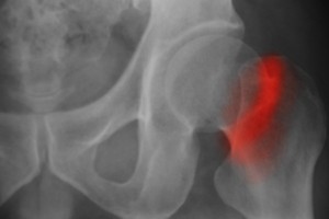 Hip fracture © Getty Images toeytoey2530