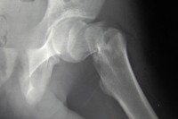 bone_xray_hip_fracture_skeleton