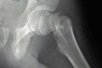 Vitamin K2 shows ‘extremely important improvements in clinical outcomes’ for bone health