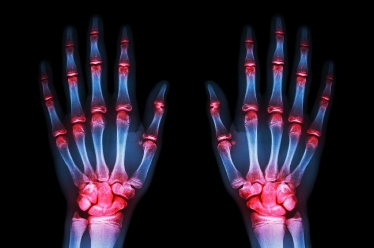 Out of joint: Industry & regulators are highly concerned by latest glucosamine ruling. ©iStock 