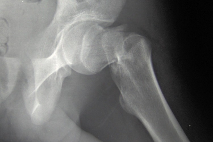 Hip fracture risk cut by carotenoids, say researchers