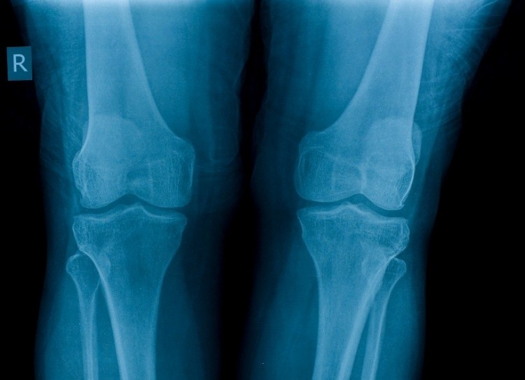 Low vitamin D levels may speed up bone aging