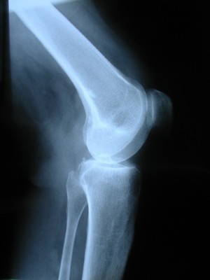 Nutrient blend may stop bone loss & reduce fracture risk: DSM study