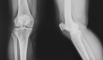 UC-II beats glucosamine & chondroitin for knee joint comfort & flexibility: InterHealth data