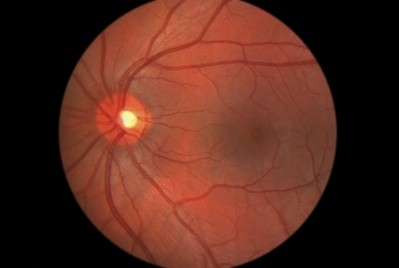 Lutein/zeaxanthin may boost retinal sensitivity for people with early AMD: Long-term study