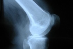 Study shows curcuminoids/piperine combo reduces knee osteoarthritis symptoms